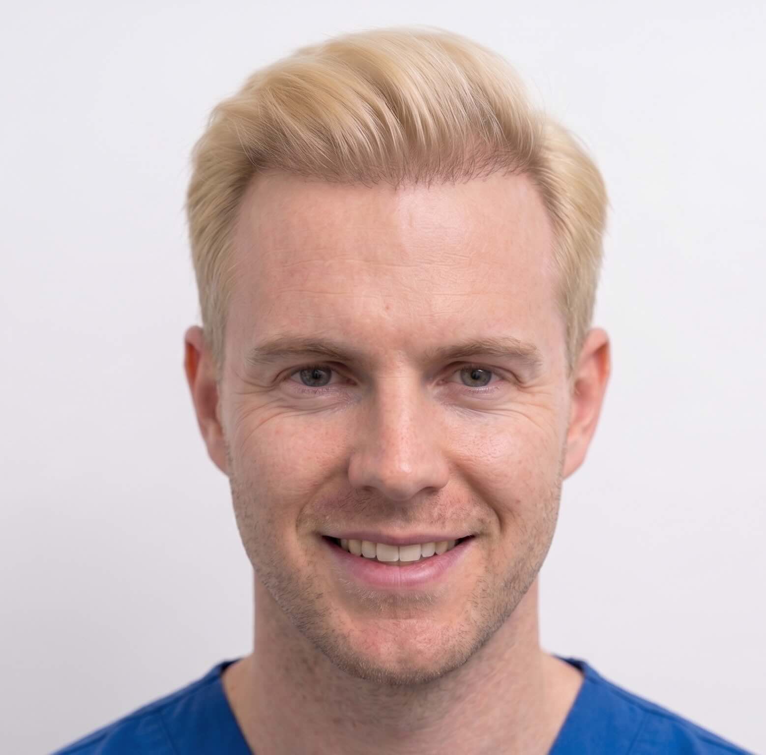 Avant — greffe cheveux